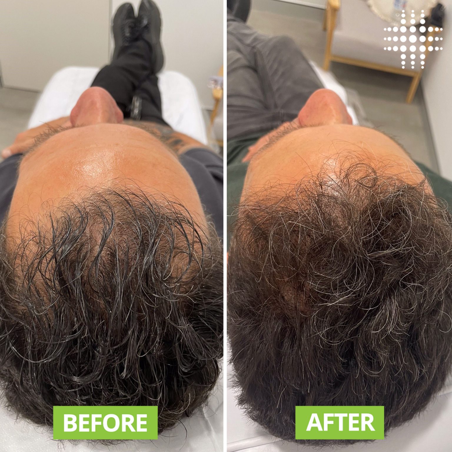 Hair Regrowth Therapy Before And After Results Results Laser Clinic