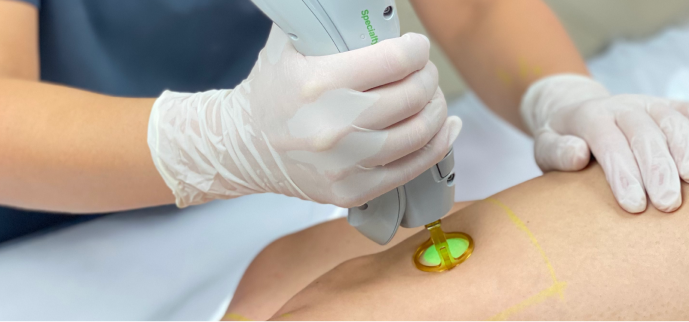 Laser Hair Removal