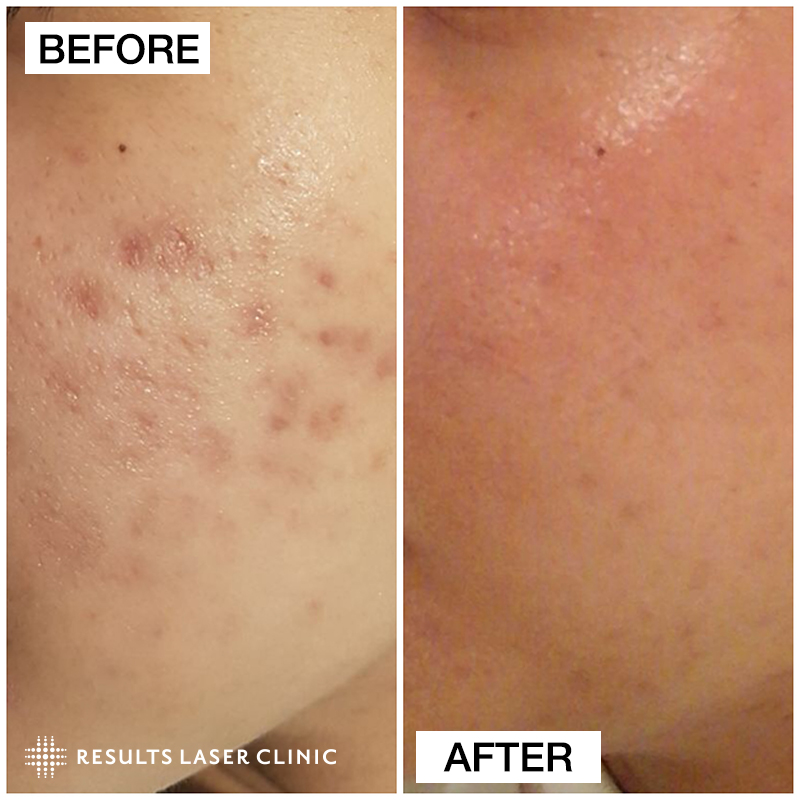 before and after results