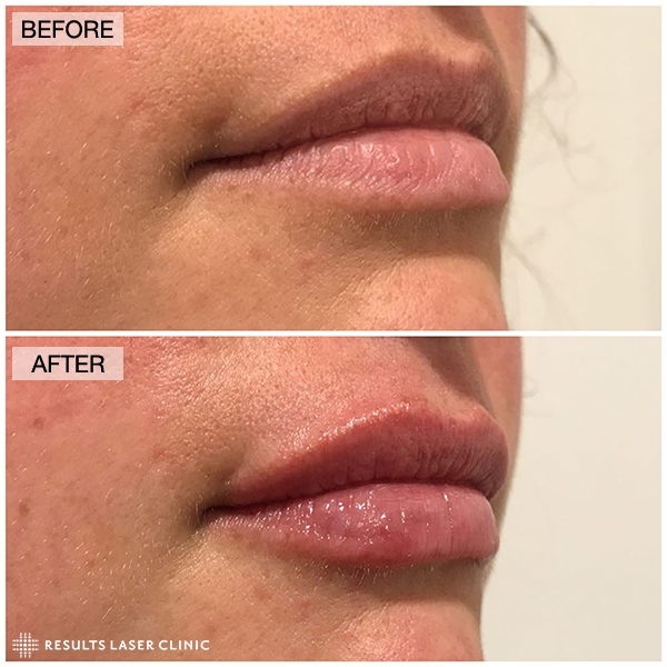 before and after
