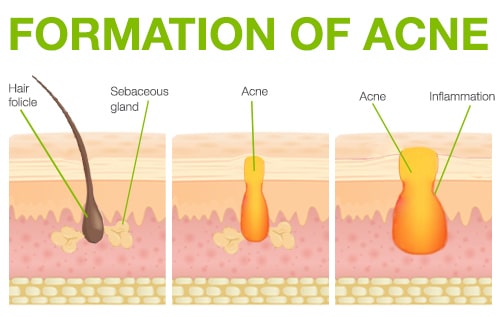 formation of acne