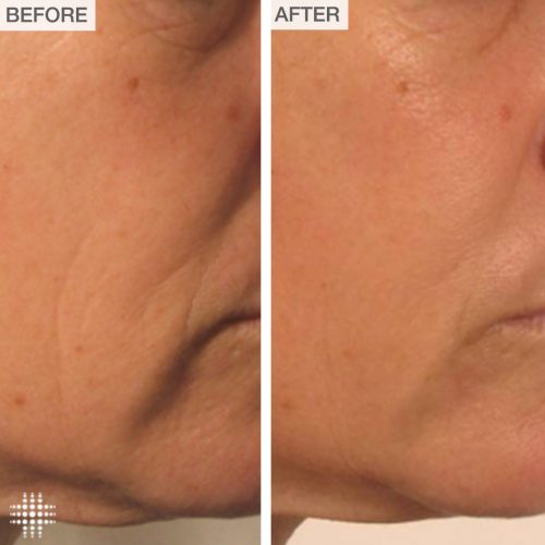 non surgical facelift