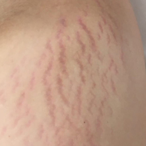 STRETCH MARK