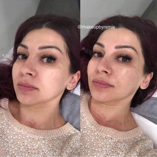 How do you get rid of dehydrated skin remie-micro treatment-photo treating dry skin