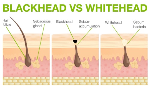 how to prevent acne BLACKHEAD-VS-WHITEHEADS blackhead vs whitehead