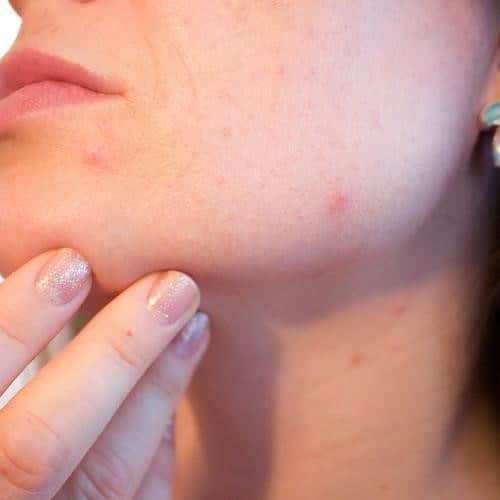 34 pimple