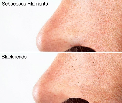 Do-blackhead-vacuums-work--blackhead-vs-Sebaceous Filaments blackhead vacuums