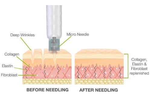 What does skin needling do? Put your best face forward | Results Laser ...