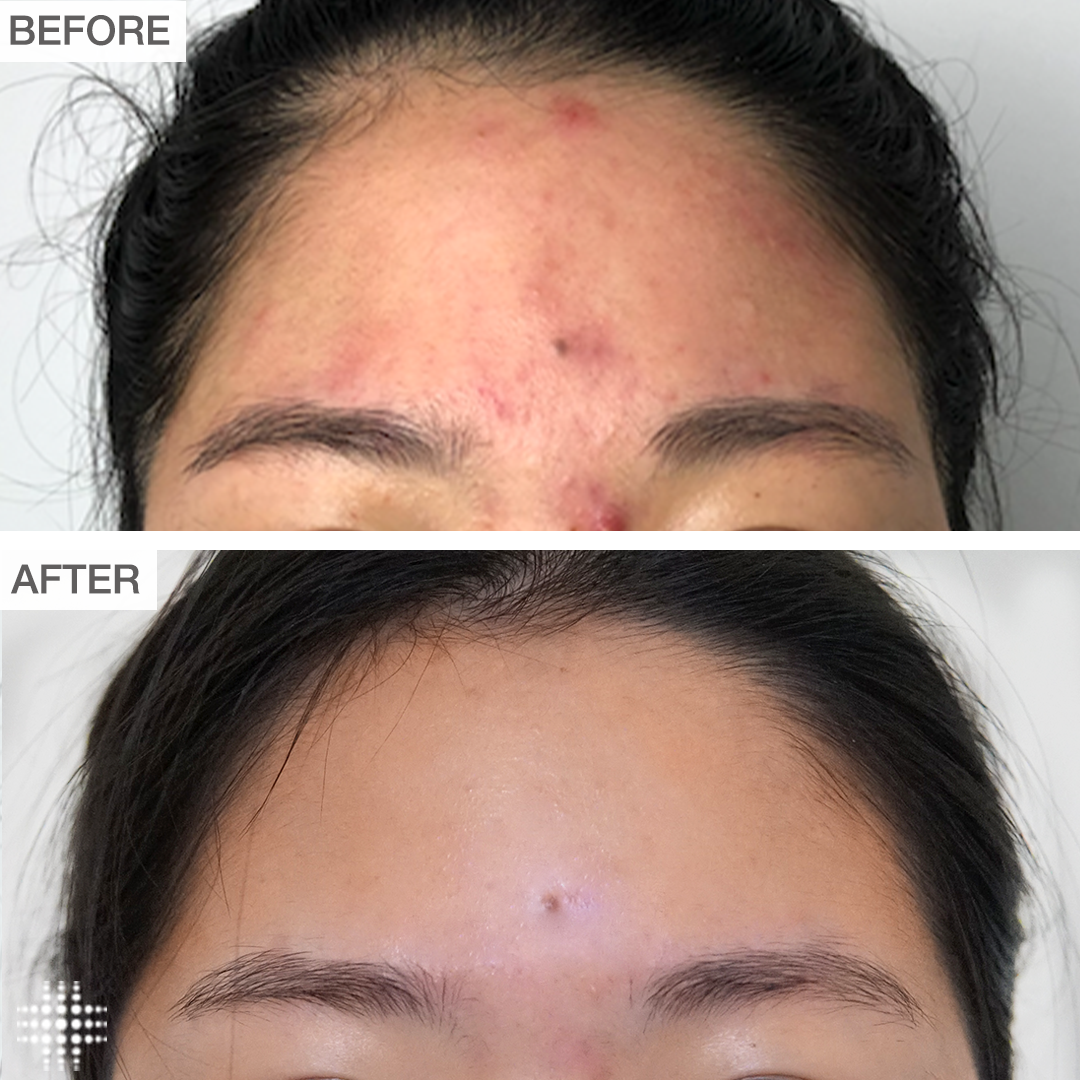 Chemical peel benefits