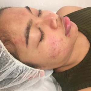 Chemical Peel