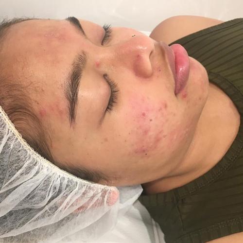 Chemical Peel