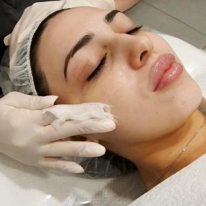 Chemical peel