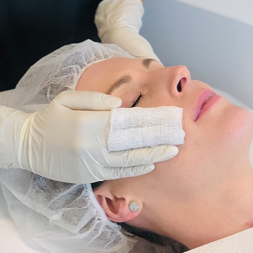 Chemical peel benefits