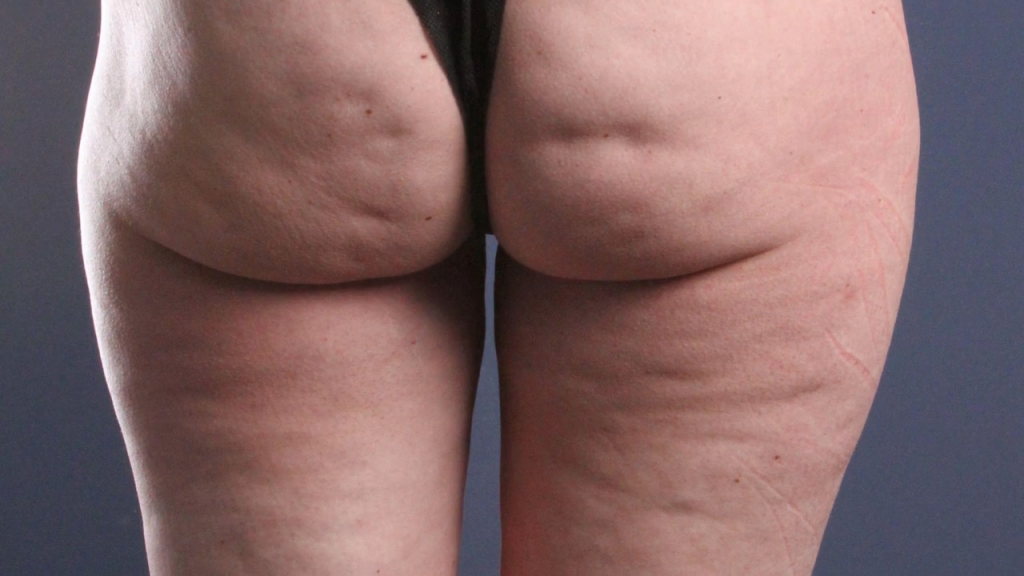 Fat Cellulite Butts