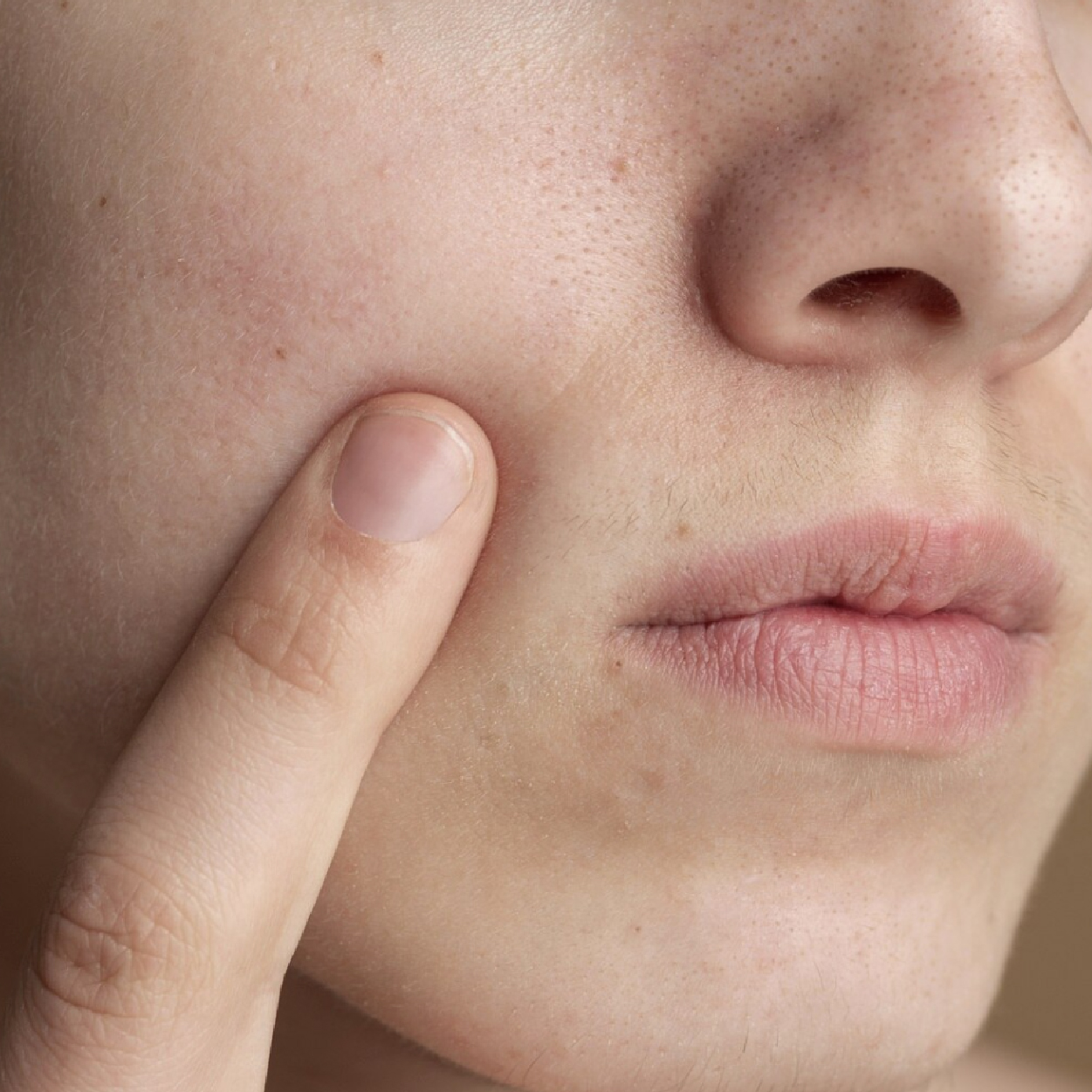 What is a blackhead?