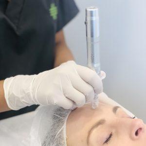 Resurfacing Benefits of Skin Needling