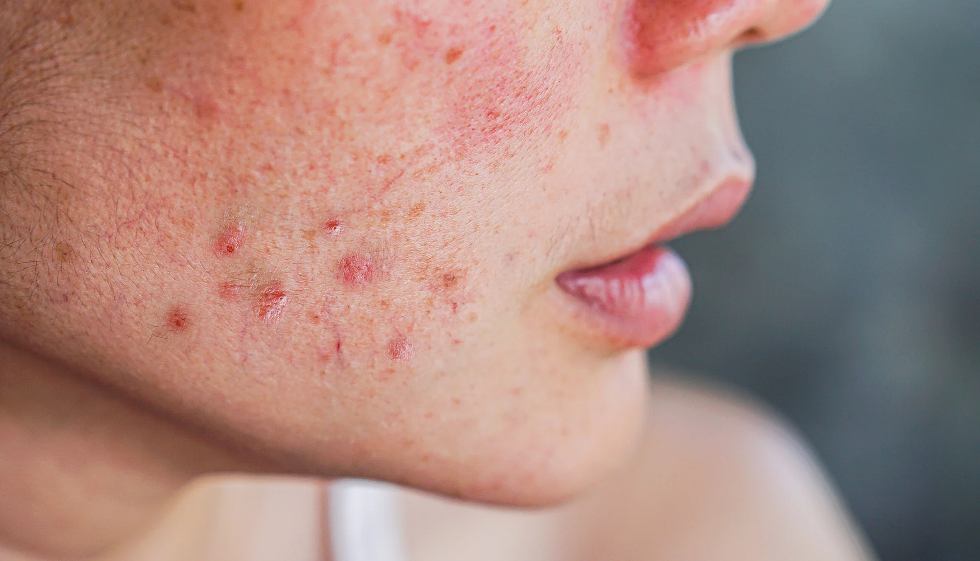 How To Get Rid of Acne Scars? Your Guide to Acne Scarring
